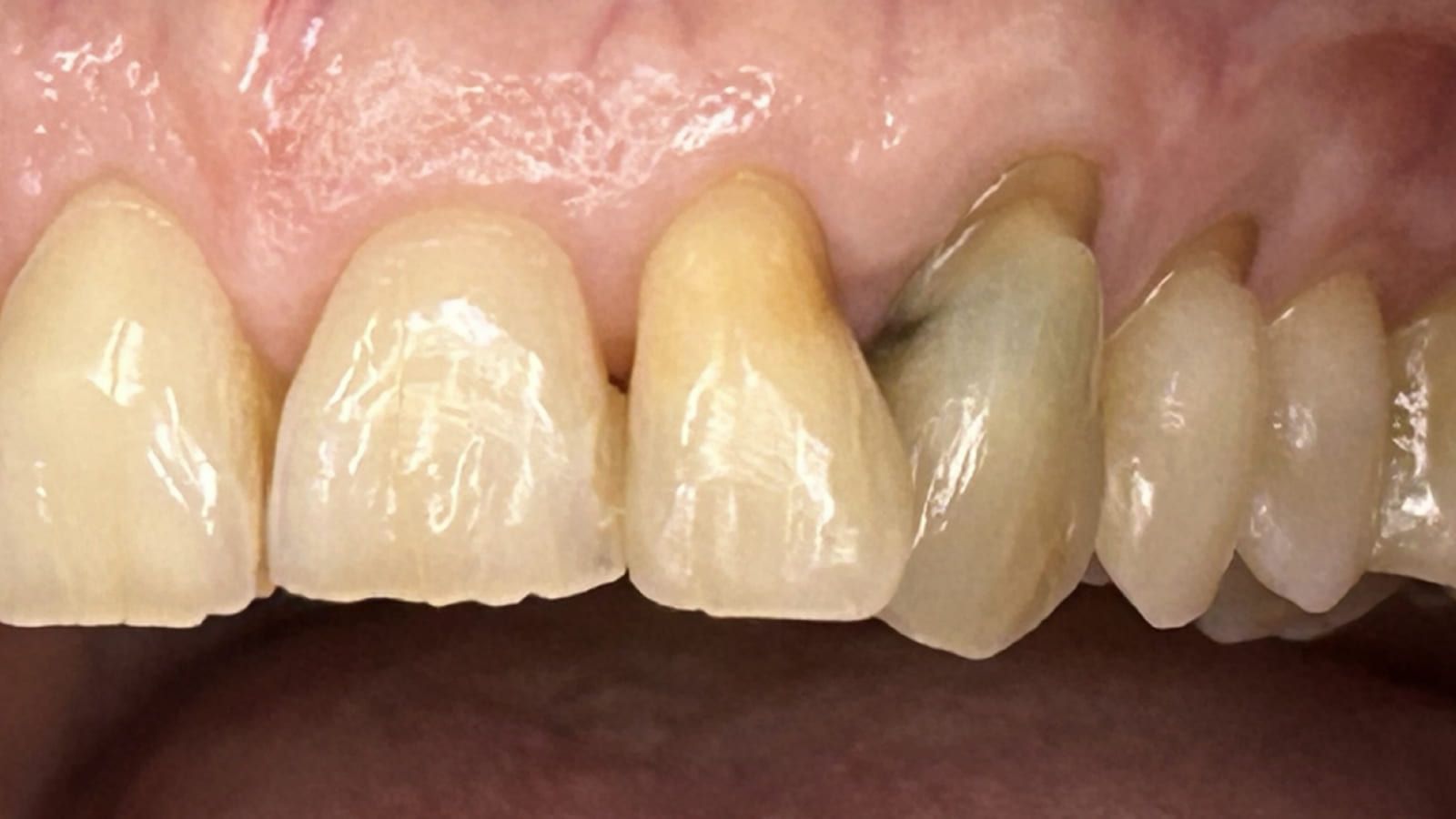 Aesthetic Improvement with Two Crowns — before treatment
