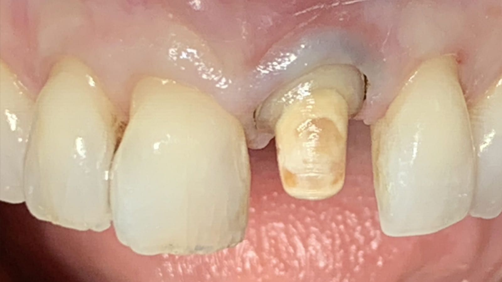 An All-Ceramic Crown Replacing a Metal-Backed One — before treatment