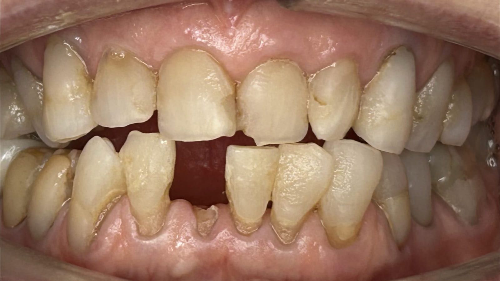 Immediate Implant for a Fractured Lower Incisor — before treatment