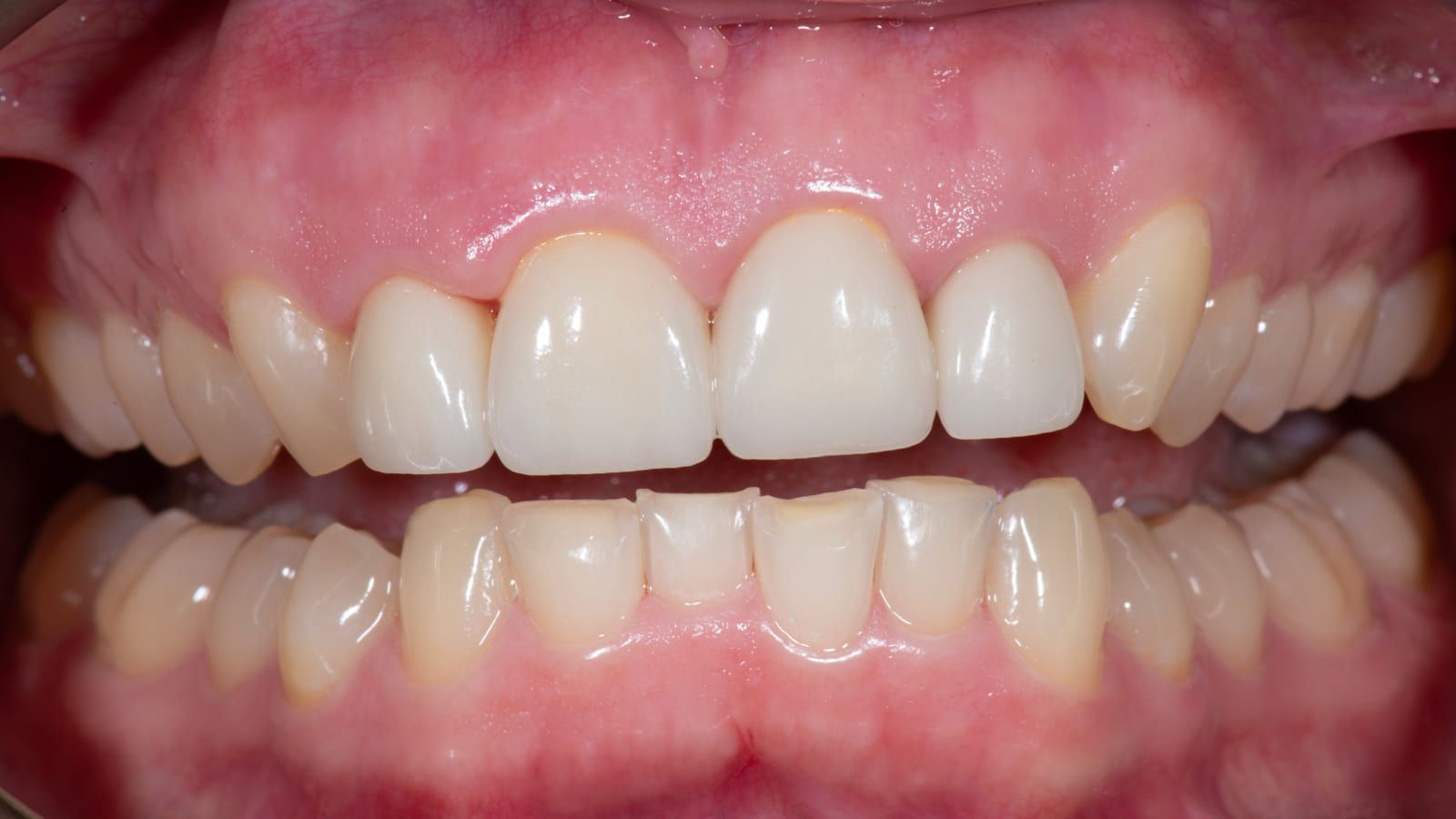 Correcting Four Ill-Fitting Front Crowns — before treatment