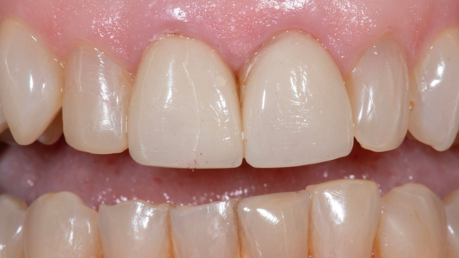 Porcelain Restorations Replacing Failing Resin — before treatment