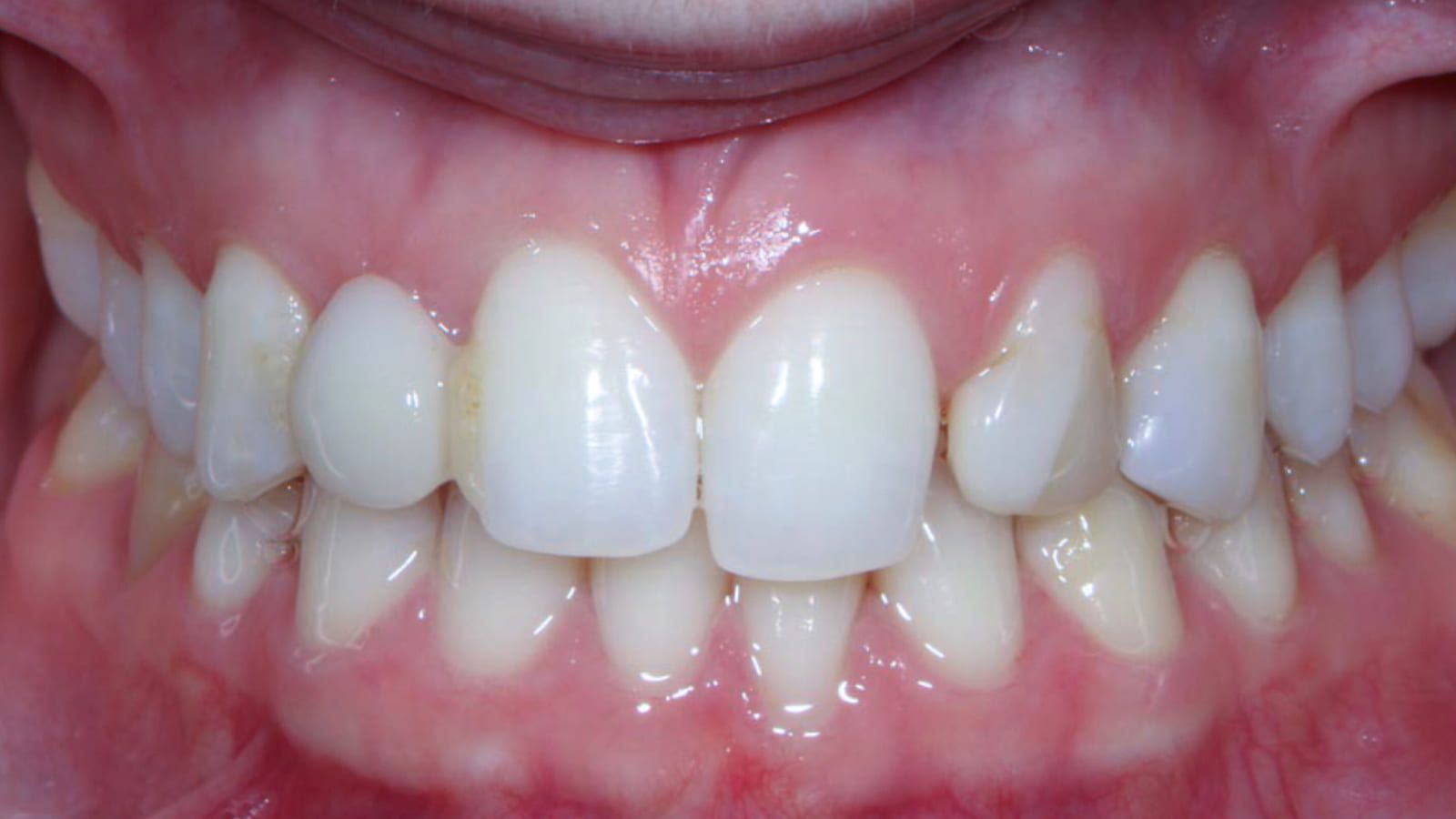 Implant & Veneers for a Missing Lateral Incisor — before treatment