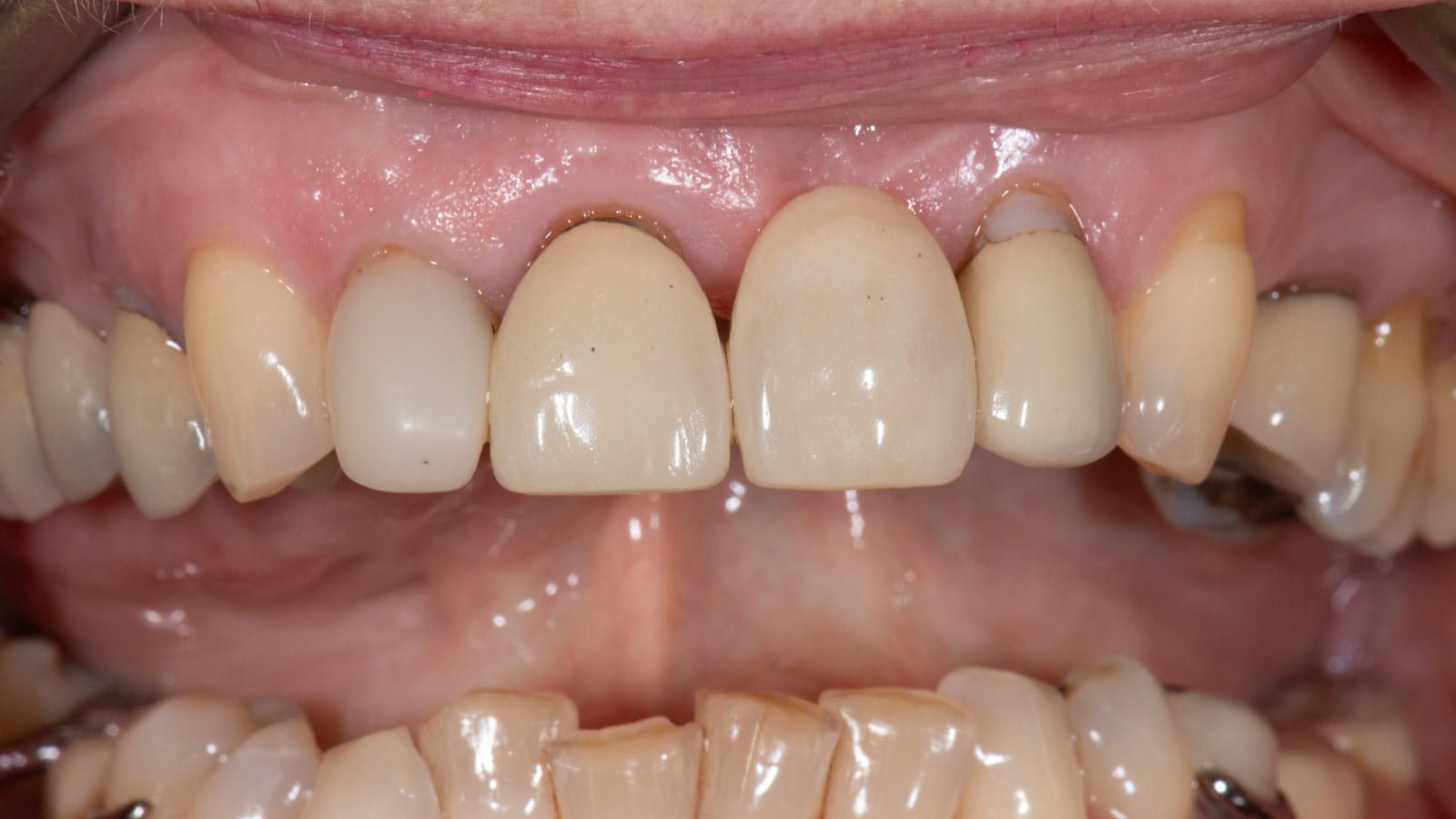 Ceramic Bridge & Crown Replacement — before treatment