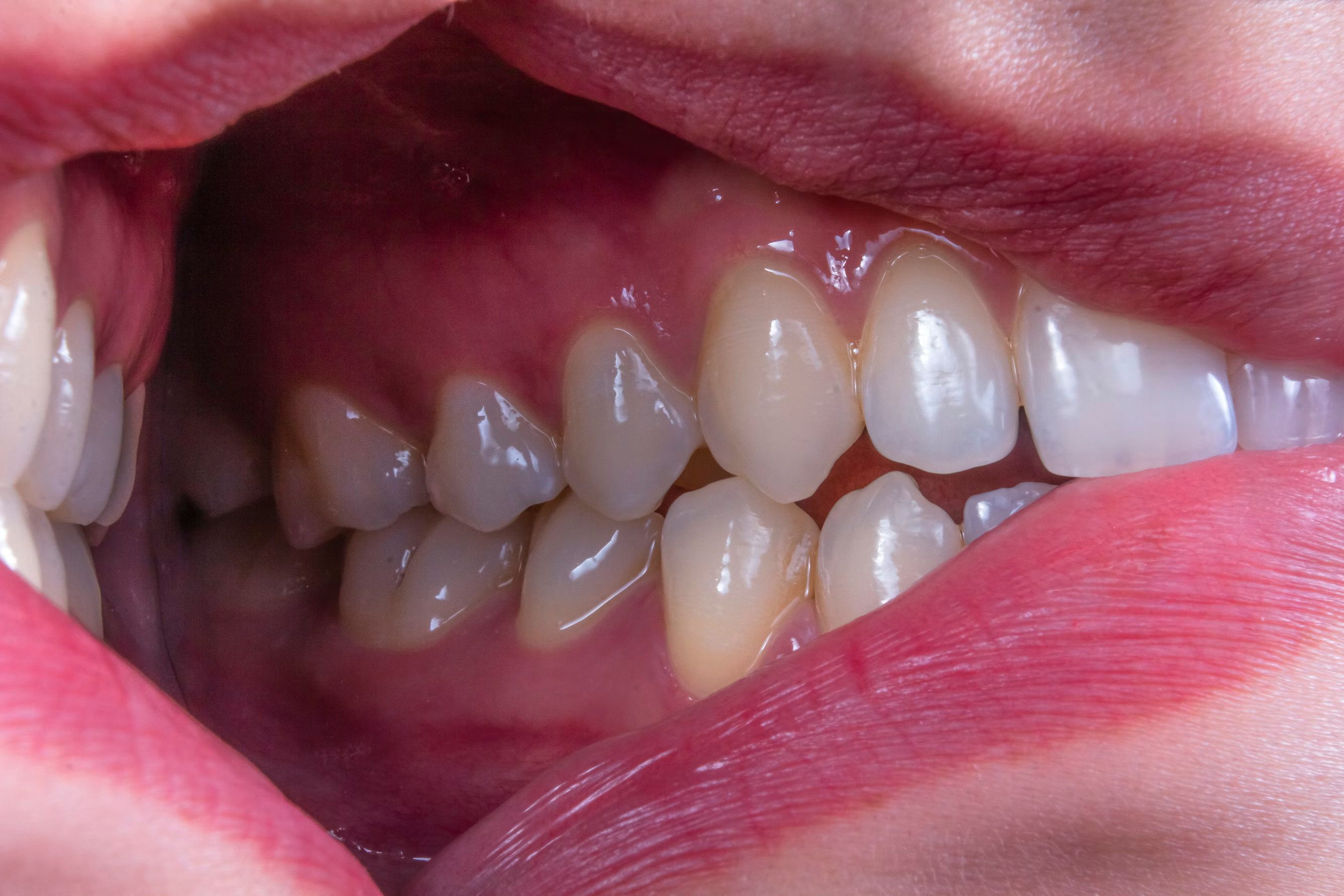Signs Your Gums Need More Attention: What to Watch For