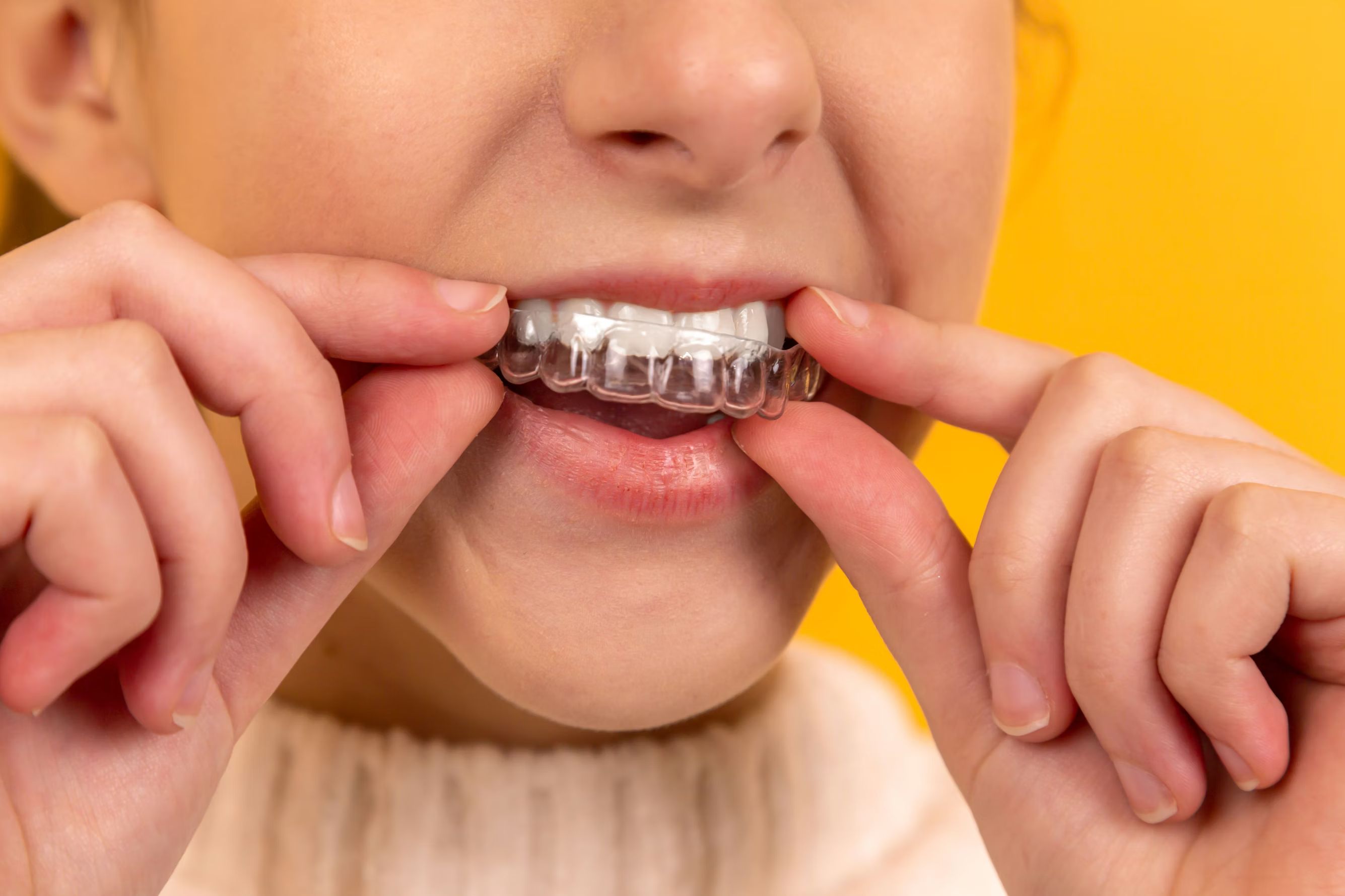 5 Tips to Maximise Your Invisalign Treatment Results