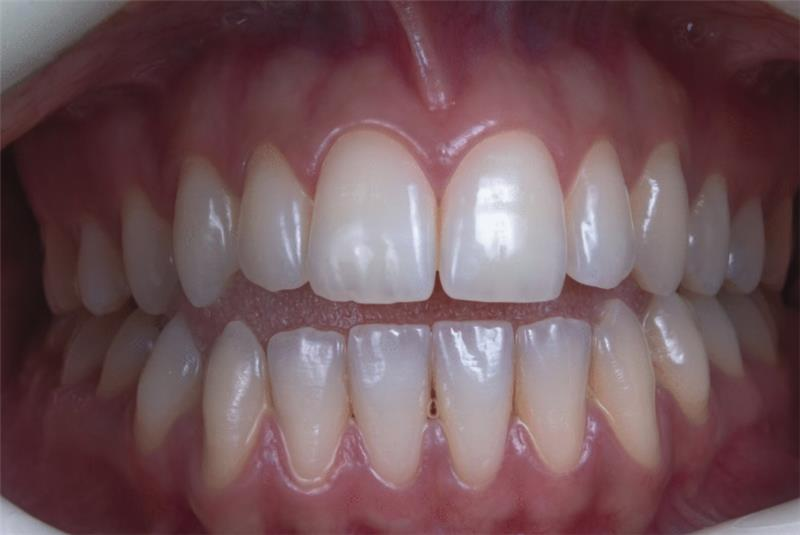 Water Picks: How Water Irrigation Devices Support Your Oral Health