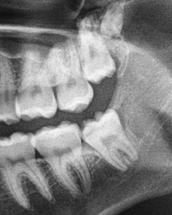 Wisdom Teeth