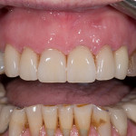 Front Crowns - Case 1