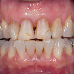 Front Crowns - Case 2