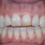 Porcelain Veneers - Case 1